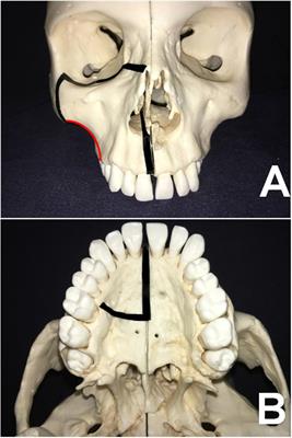 Modified Maxillary-Swing Approach for Resection of Primary Malignancies in the Pterygopalatine Fossa